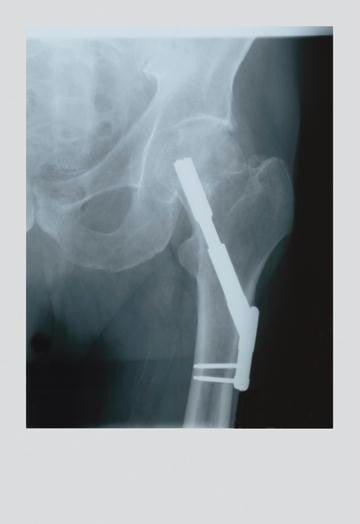 Fixed Femur 20x30 poster