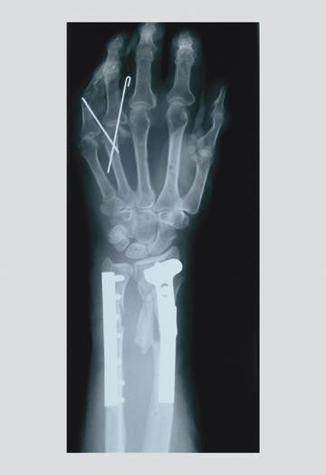 Arm and Finger Repair 20x30 poster