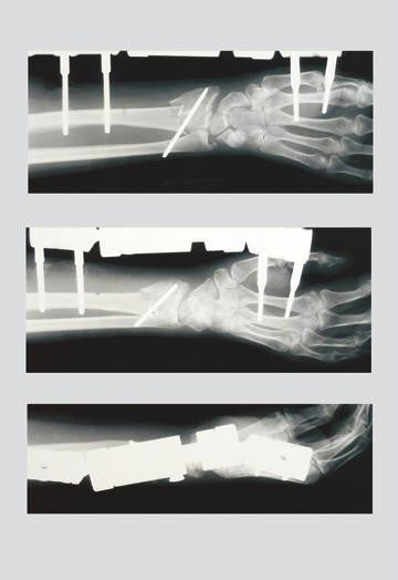 Arm with External Fixation 20x30 poster