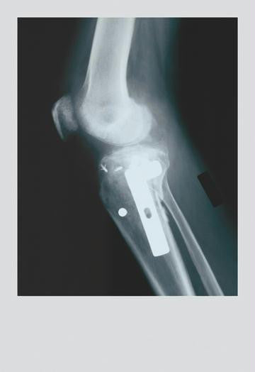 Knee Replacement 12x18 Giclee on canvas